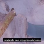 Producir una estenosis en un conducto