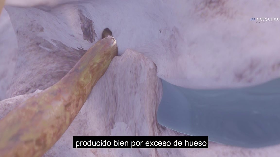 Producir una estenosis en un conducto