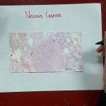 Producir la muerte de un tejido en un ser vivo