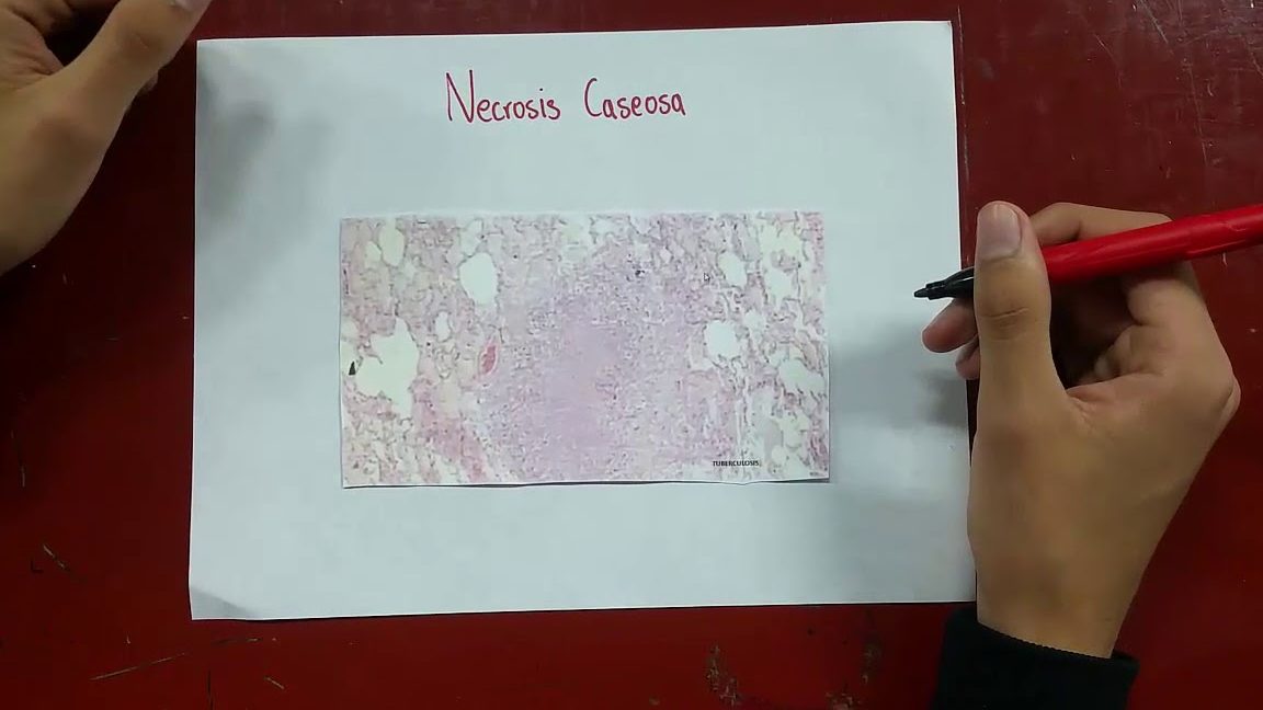 Producir la muerte de un tejido en un ser vivo